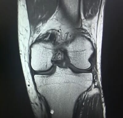 50代男性の膝のMRI画像