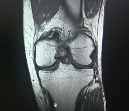 【膝MRI】50代後半｜半月板断裂の症例を解説します