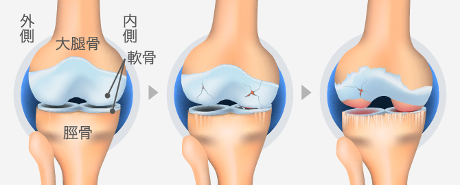 変形性膝関節症の起こるメカニズム