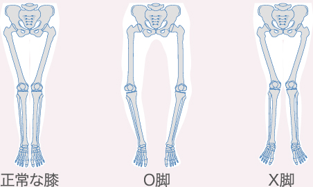 O脚・X脚の軟骨へのダメージ