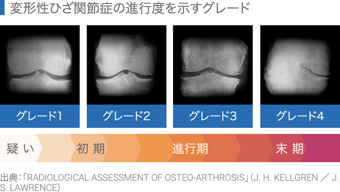 変形性膝関節症の進行度を示すグレード