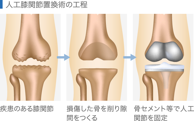 人工関節置換術の工程