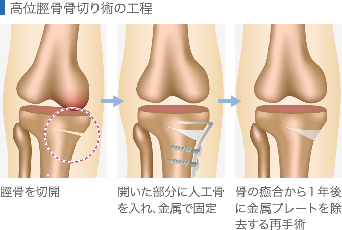 高位脛骨骨切り術