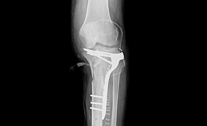 高位脛骨骨切り術の工程