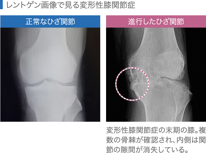 レントゲン画像で見る変形性膝関節症