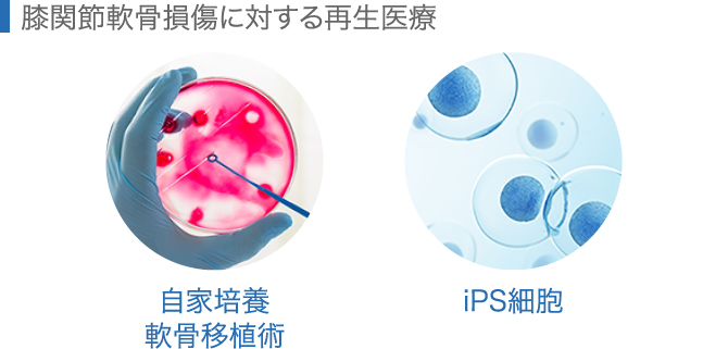 膝関節軟骨損傷に対する再生医療