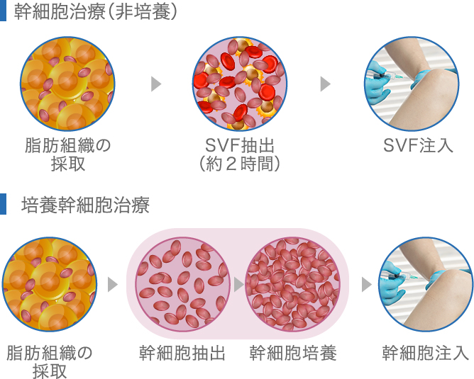 幹細胞治療（非培養）と培養幹細胞治療