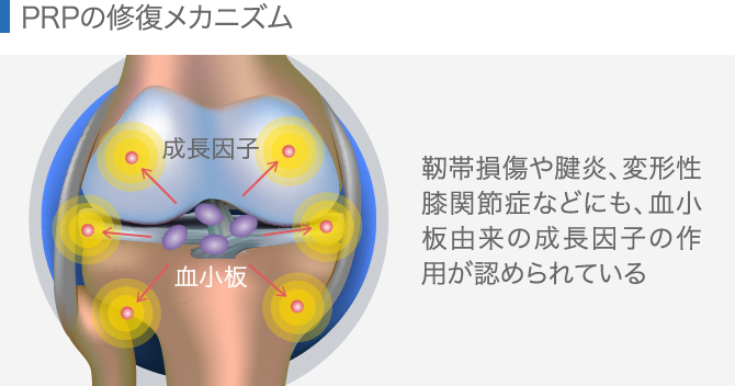 PRPの修復メカニズム