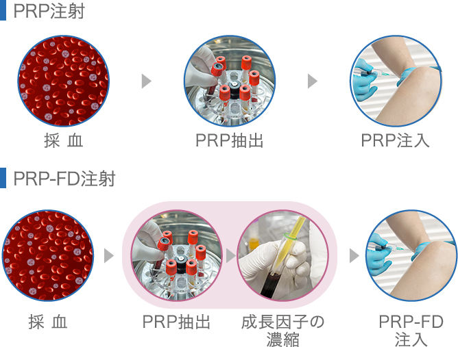 PRP注射とPRP-FD注射